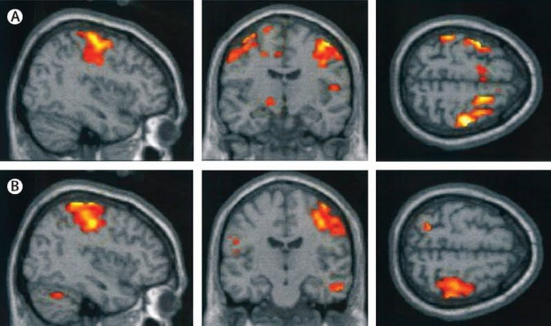 8uH2AxD The Global Silent Pandemic of Neurodevelopmental Toxicity