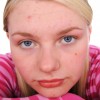 Dairy Aggravates Acne